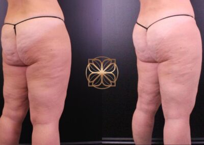 Before and after views of Cellfina Cellulite Reduction treatment in Beverly Hills, demonstrating significant reduction in cellulite on the thighs and buttocks