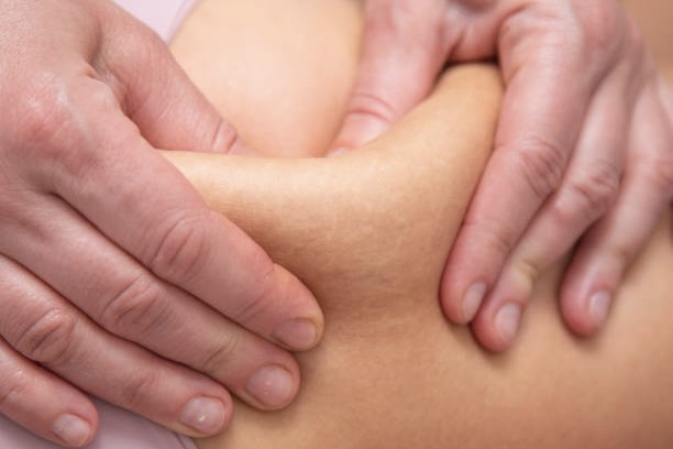 Cellfina Cellulite Reduction Side Effects and Risks