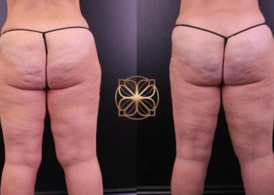 Cellfina cellulite reduction treatment before and after photos from a Beverly Hills clinic, showing smoother skin on the thighs and buttocks