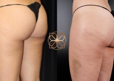Advanced results of Cellfina Cellulite Reduction treatment showing significant cellulite diminishment on the buttocks and thighs