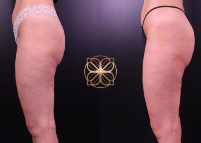 Cellulite reduction transformation achieved with Cellfina treatment, demonstrating a more toned and smooth appearance of the thighs