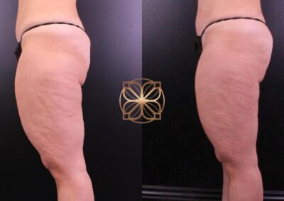 Transformation after cellulite reduction treatment on thighs, exhibiting significantly smoother skin and contouring