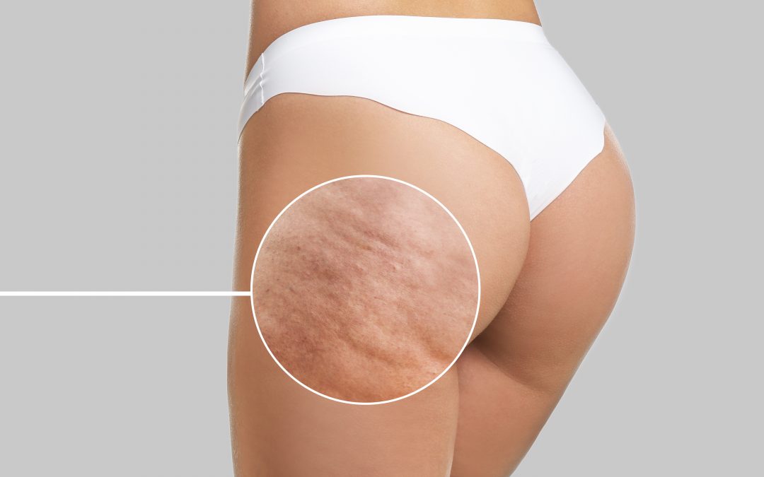 Cellfina Cellulite Treatment Beverly Hills