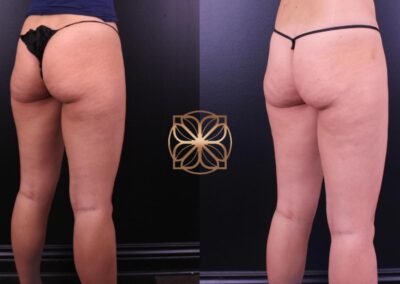 Successful cellulite reduction on buttocks visible in post-treatment comparison, showcasing a smoother skin surface