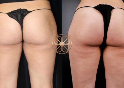 Before and after comparison of Cellfina cellulite treatment showing the reduction of cellulite for a smoother buttock appearance