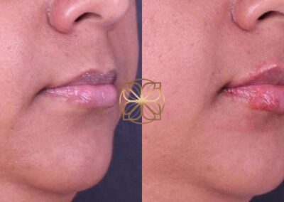 Close-up view of lip enhancement with filler treatment, showing increased fullness and defined lip contours