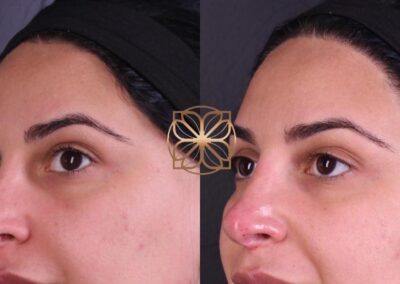 Close-up profile view of non-surgical rhinoplasty with nose filler, showing subtle enhancement and contouring