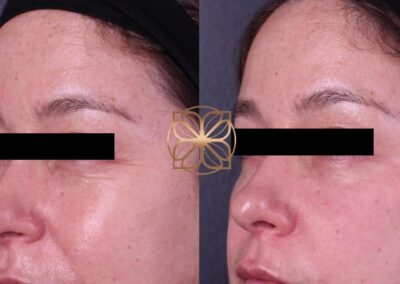 Close-up side profile before and after tear through filler, showing a reduction in eye lines and refreshed under-eye area