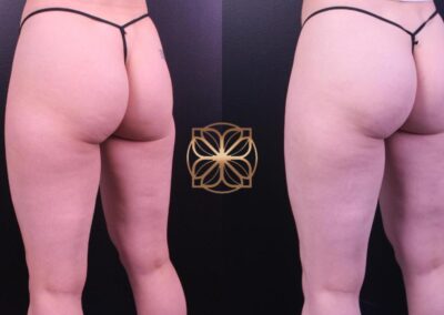 Post-procedure results of combined liposuction and Cellfina on the outer thighs, illustrating significant smoothing and contouring