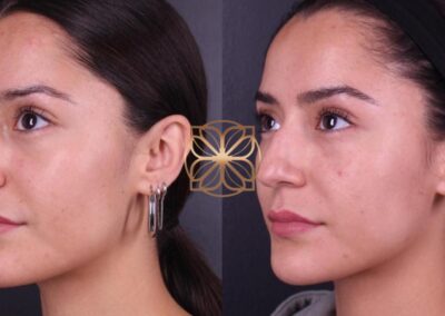 Results of full facial Botox and filler treatments including chin, gummy smile, nose, tear troughs, lips, and marionettes, displayed in profile view