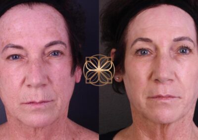 Progress of advanced facial treatment showing side profile before and after Erbium, FaceTite, lip lift, and earlobe reduction at a Beverly Hills clinic