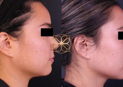 Side profile before and after comprehensive facial rejuvenation with Botox, filler, and buccal fat pad removal, showcasing a refined facial structure
