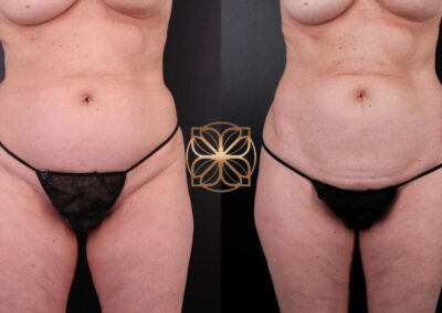 Before and after CoolSculpting treatment comparison, demonstrating significant fat reduction and smoother abdominal contours