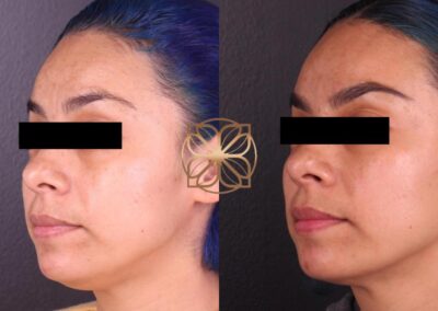 Profile view of cosmetic enhancements with Botox and fillers, showing improved facial contours and skin texture