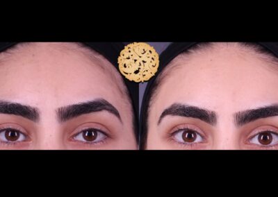 Before and after view of a female patient's face showing results of dermaplaning skin treatment.