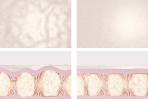 During Cellfina Cellulite Reduction