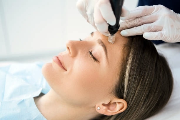 during microneedling prp