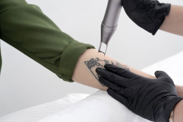during tattoo removal
