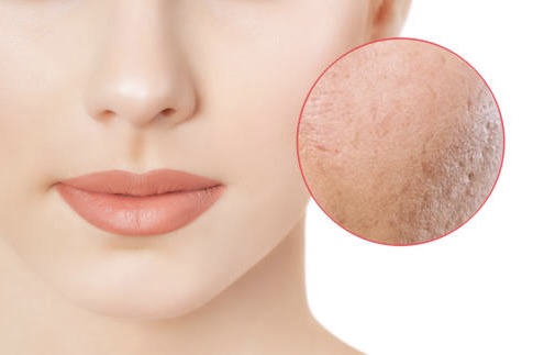 Erbium Contour TRL Resurfacing Benefits