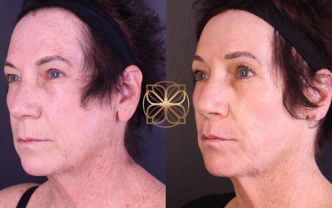 Erbium Contour TRL Resurfacing Beverly Hills