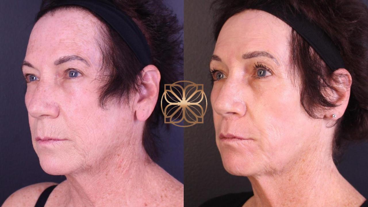 erbium-laser-skin-resurfacing-before-after Before and after results of Erbium Contour TRL skin resurfacing treatment for improved skin texture and wrinkle reduction.