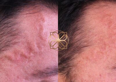 Before and after visualization of Excel V laser treatment on the face, demonstrating improvements in skin texture and clarity