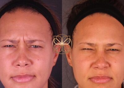 Before and after of expressive Botox treatment, showcasing reduced frown lines while retaining the ability to express emotion