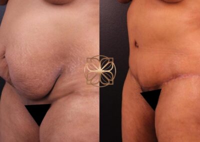 Results at 3 months post-extended abdominoplasty, BodyTite, and liposuction on thighs and arms, alongside breast lift and fat transfer, showcasing a dramatically reshaped figure