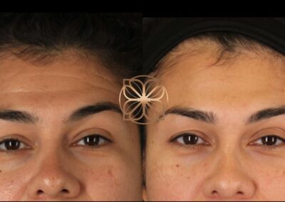 Detailed before and after comparison of Botox treatment on the eye area, showing visible reduction of fine lines and wrinkles