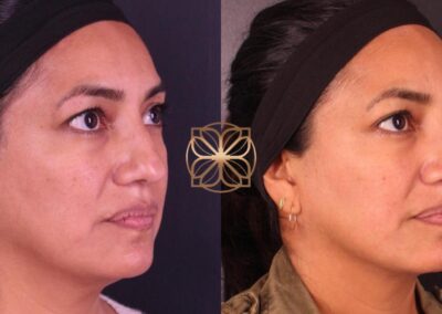 Side profile comparison of facelift and skin rejuvenation from FaceTite and Morpheus8 treatments, highlighting enhanced facial contours
