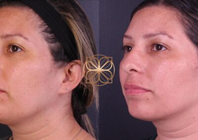 Side view of facial skin tightening results from FaceTite treatment after three months, showing a refined jawline and facial structure
