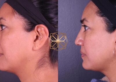 Profile view before and after FaceTite and nose filler procedure, depicting facial refinement and contouring