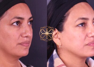 Side view comparison of FaceTite and nose filler treatment results for facial aesthetic improvement