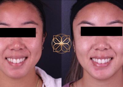 Front view facial transformation with Botox and fillers to midface, tear troughs, lips, and chin, showing rejuvenation and symmetry