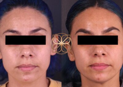 Before and after results of facial Botox and filler treatments for enhanced facial symmetry and wrinkle reduction
