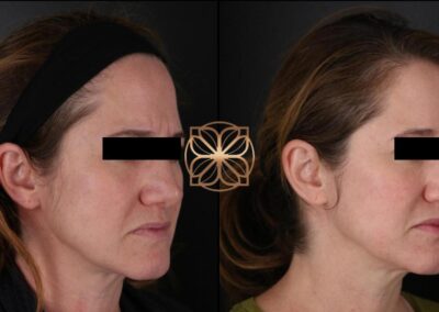 Facial rejuvenation with Botox treatment, side profile before and after comparison highlighting wrinkle reduction