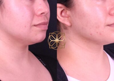 Enhanced facial contour and neckline post-Buccal Fat Removal and FaceTite treatment, evident in the side-profile comparison
