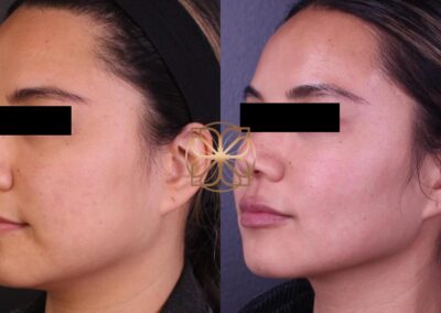 Profile view showing facial contour enhancement after Botox, filler application, and buccal fat pad removal
