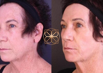 Side view of facial contouring enhancement five months post-Erbium, FaceTite, lip lift, and earlobe reduction procedures in Beverly Hills