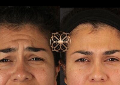 Comparison of facial expressions before and after Botox treatment, showcasing the reduction of forehead and frown lines