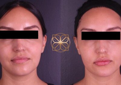 Before and after facial filler enhancements on nose, lips, tear troughs, and chin, showcasing aesthetic improvements
