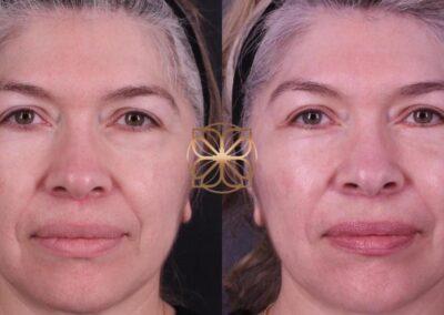 Before and after facial transformation with filler to temples, piriform, midface, and lower blepharoplasty after two months, showing rejuvenated appearance