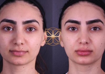 Front view before and after facial filler treatment on lips, nasolabial folds, marionette lines, and nose, showing enhanced facial definition