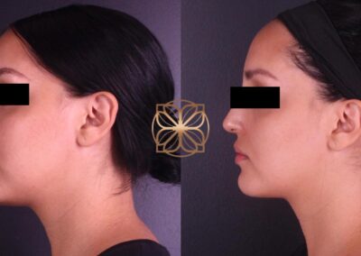 Side profile comparison of facial enhancement with fillers in the nose, lips, tear troughs, and chin