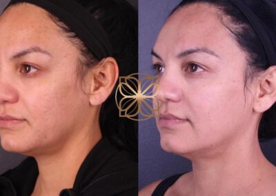 Before and after view of facial and neck contouring treatment highlighting enhanced skin texture and tone