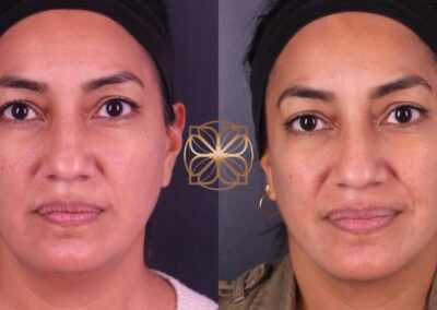 Front view facial rejuvenation results after FaceTite and Morpheus8 treatments, showing improved skin texture and tone