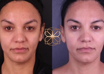 Comparison of facial rejuvenation and neck treatment outcomes showing clear skin improvement