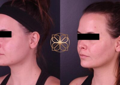 Profile view of facial skin enhancement three months after FaceTite and BFPR treatments, revealing a refined skin texture in Beverly Hills