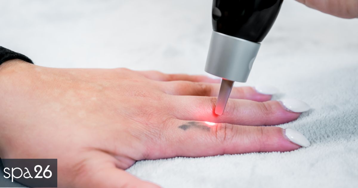 Factors That Affect the Speed of the Tattoo Removal Process