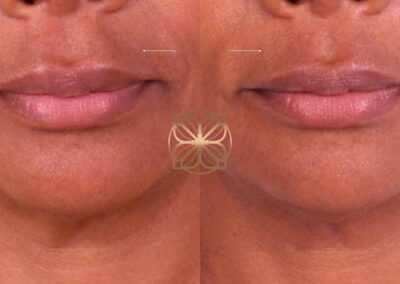Before and after lip filler reversal with Hylanex, showing natural lip contour restoration